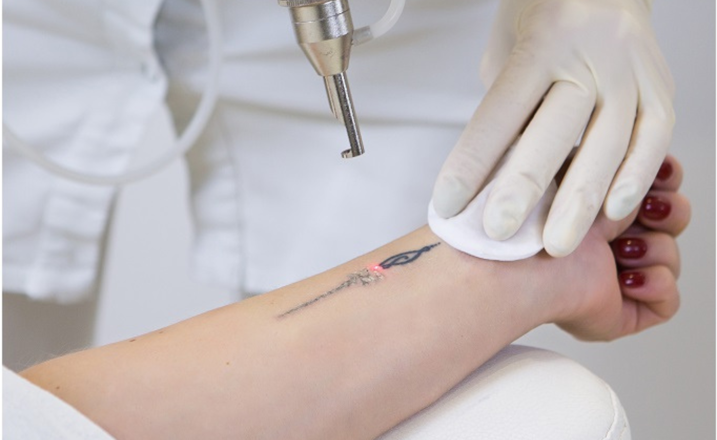 Pico-laser tattoo removal: Kun je écht een tatoeage in één keer laten weglaseren? De schokkende waarheid!